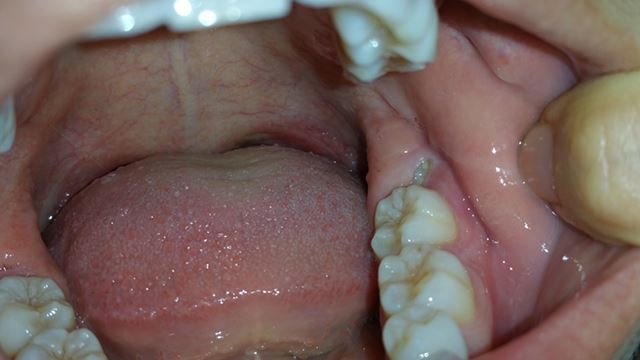 wisdomteeth-640.png