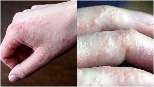 handdermatitis640.jpg