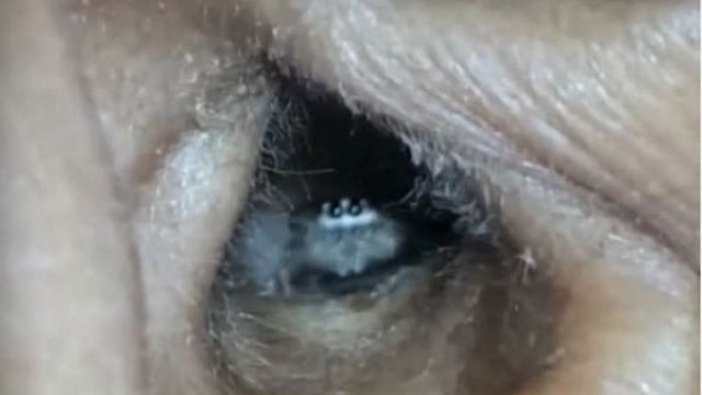 spider-inside-an-ear-1_2.png