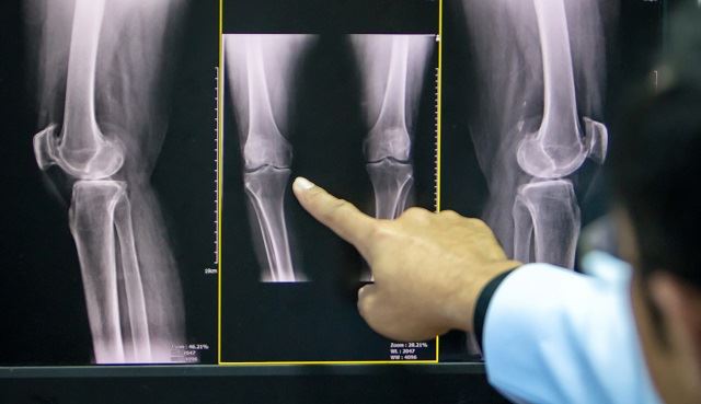 5 medical facts that you should know about that pain in your knees