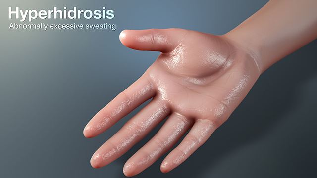 hyperhydrosis640-jpg.png