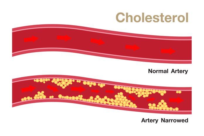 ini tanda badan korang tinggi kolestrol walaupun kurus keding