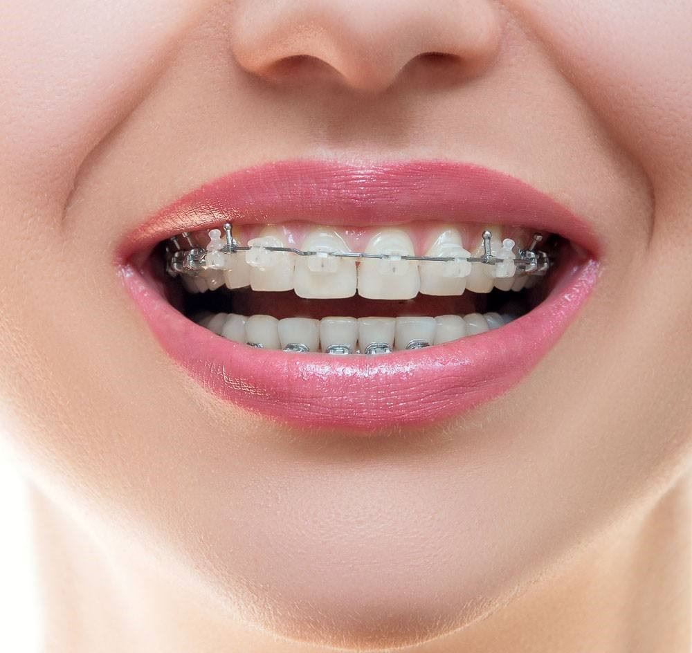 「绑牙」是一辈子的事！弄之前必先知道的5大真相！