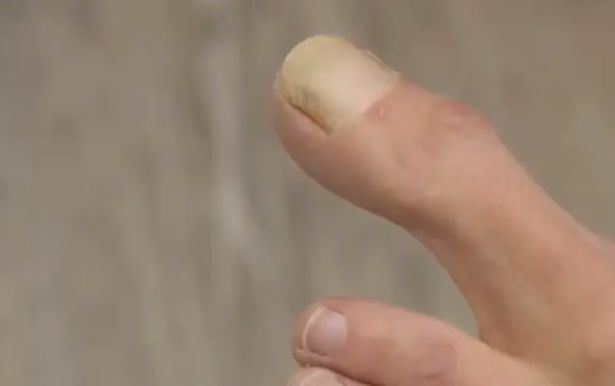 doktor terkejut lihat ibu jari kaki wanita ini besar dari biasa