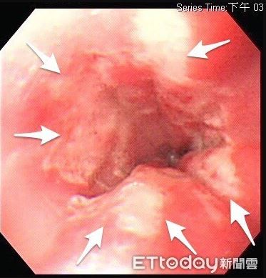 pelajar 23 tahun cedera esophagus lepas telan ubat tanpa minum air