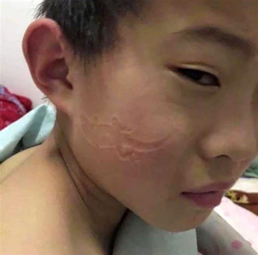 kid accidentally sleeps on a lizard which left a cicak imprint on his face
