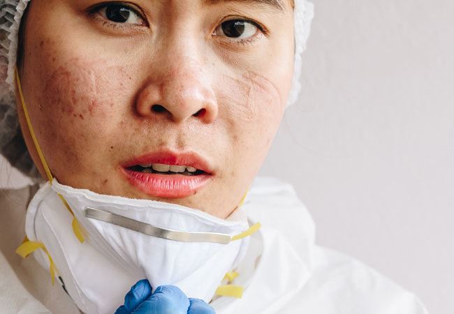 ini rupanya sebab muka naik jerawat bila pakai facemask