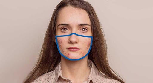 ini rupanya sebab muka naik jerawat bila pakai facemask