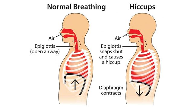 hiccup