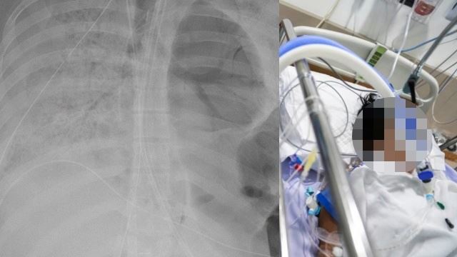 kaedah pesakit covid-19 ditidurkan bukan suatu pengakhiran, masih ada harapan untuk sembuh