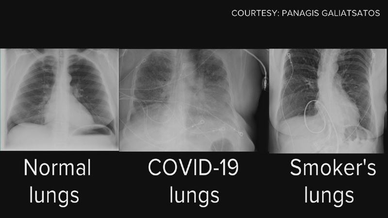 are covid lungs worse than a smoker’s lungs?