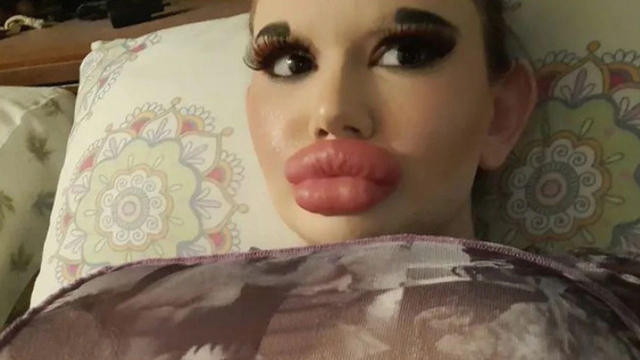 tak cukup besar, wanita bibir terbesar di dunia mahu besarkan lagi bibirnya