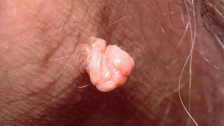 cuka epal, kulit oren antara bahan boleh guna buang ketuat badan