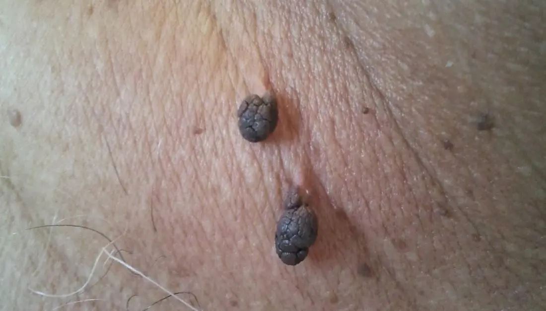 cuka epal, kulit oren antara bahan boleh guna buang ketuat badan