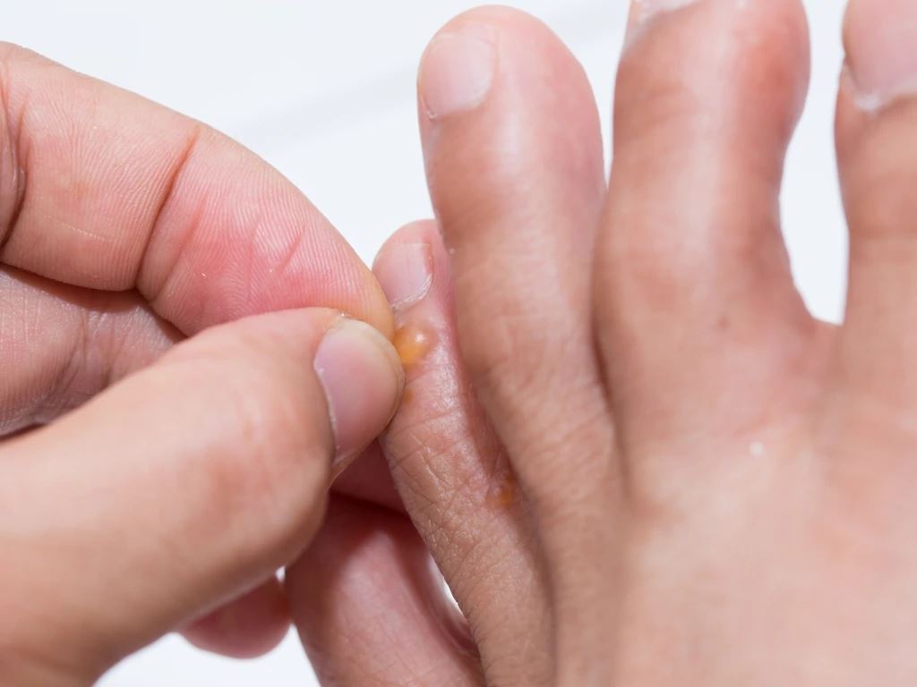 jangan garu jika kulit anda ada biji kecil & gatal macam ni