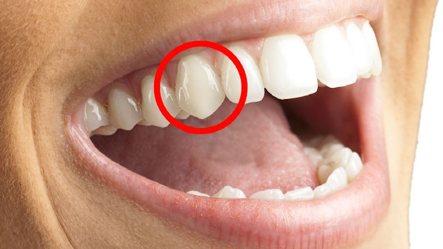 why do some people have “vampire teeth” & can it be fixed?