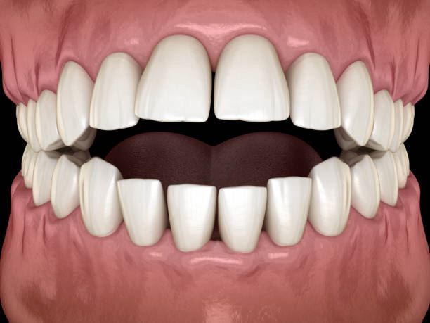 why do some people have “vampire teeth” & can it be fixed?
