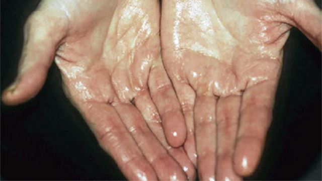 ada masalah tangan kerap berpeluh? korang mungkin ada hiperhidrosis