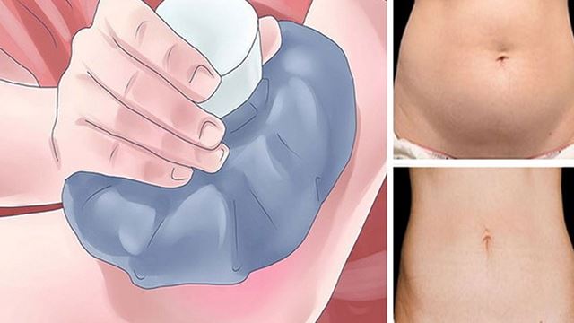 letak ais pada kawasan berlemak cara mudah untuk bakar kalori?