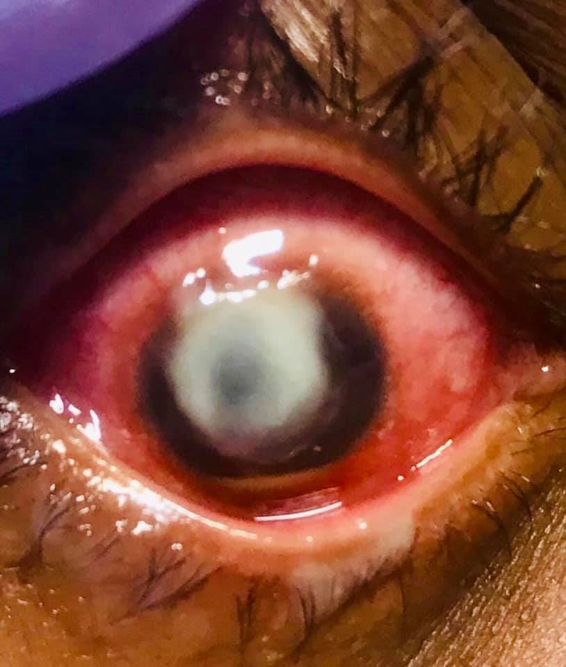 doctor shows bacteria that ate away woman’s cornea after she slept with her contact lenses on