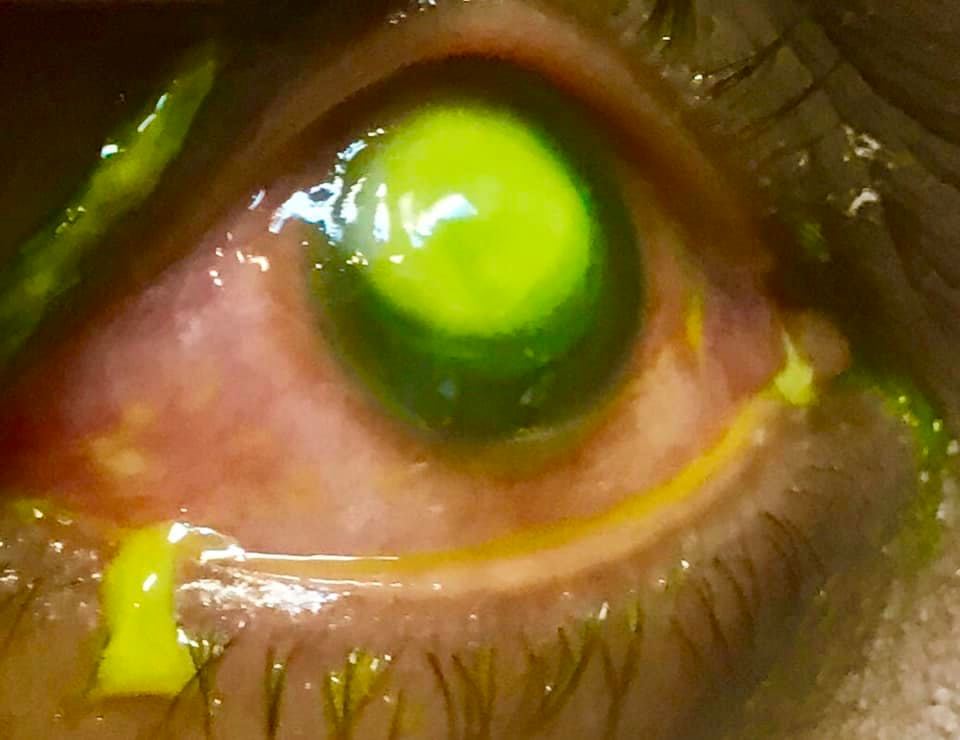 doctor shows bacteria that ate away woman’s cornea after she slept with her contact lenses on