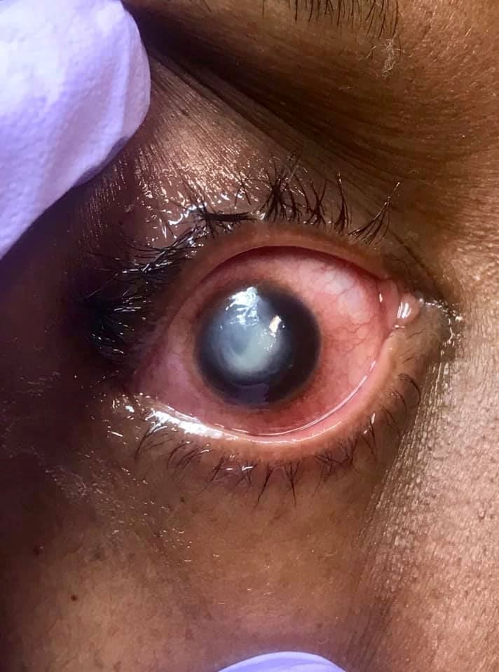 doctor shows bacteria that ate away woman’s cornea after she slept with her contact lenses on
