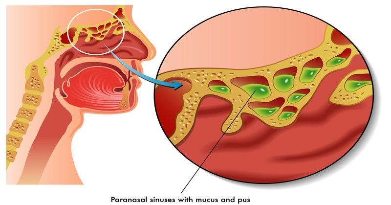 tak sangka bawang boleh guna rawat hidung tersumbat!
