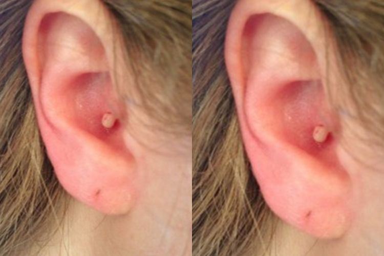 5 cara merawat jerawat dalam telinga