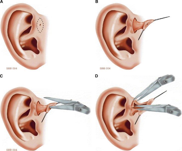 tak ramai ada lubang kecil atas telinga seperti ini