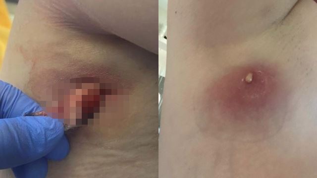 remaja nyaris maut akibat digigit labah-labah berbisa ketika seronok bercuti