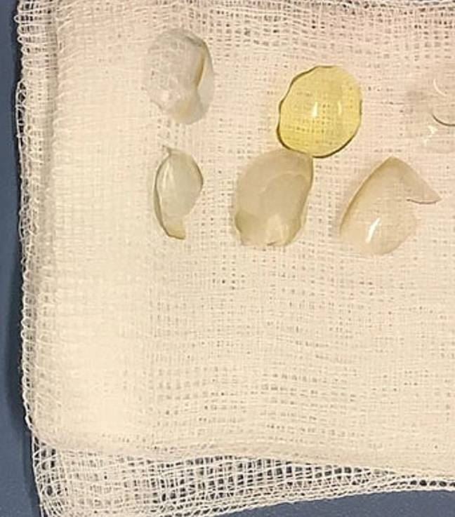 surgeon finds 27 contact lenses stuck behind woman’s eye 