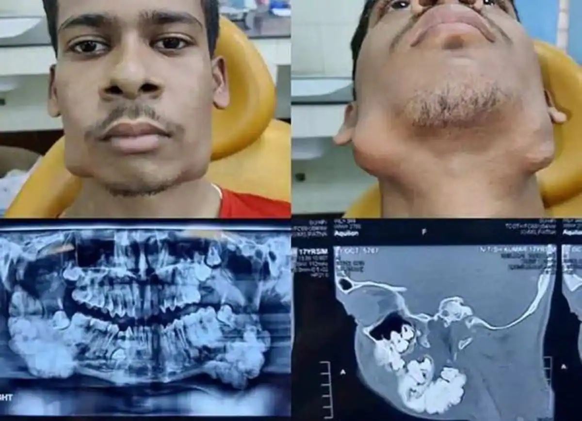 ramai terkejut lihat gigi tambahan tumbuh pada rahang lelaki ini