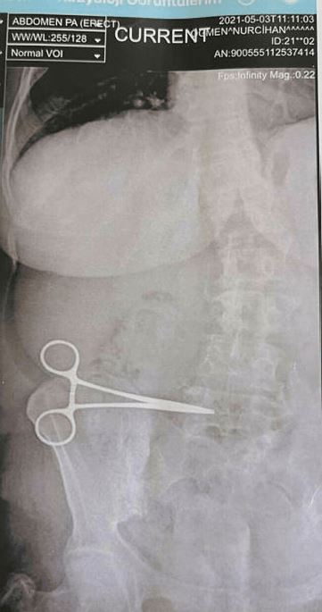 woman discovers scissors in stomach that was left behind from previous surgery