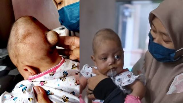 bayi 3 bulan derita otak terkeluar, keluarga tabah hadapi ujian