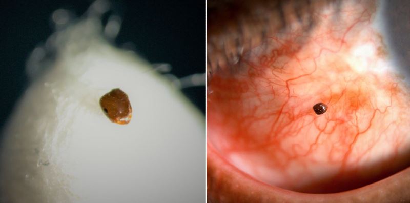 ophthalmologist shares how an ant entered a man’s eye while riding his motorcycle