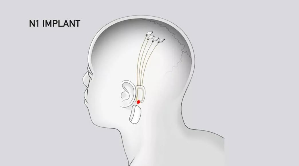 ciptaan ini benarkan anda dengar muzik terus kedalam otak