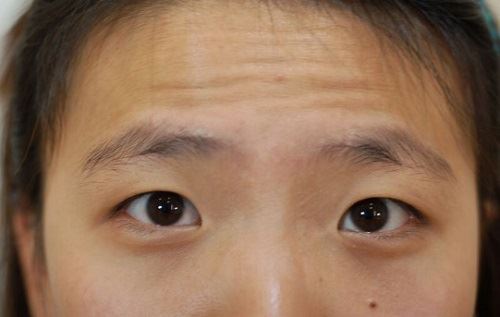 脸上有皱纹很显老？教你9个减少皱纹的妙招！赶快记起来！