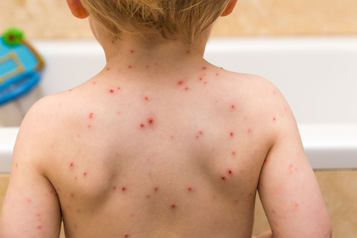 orang dewasa pun boleh terkena chicken pox, semak puncanya disini!