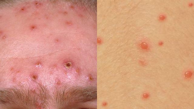 chickenpox640.png