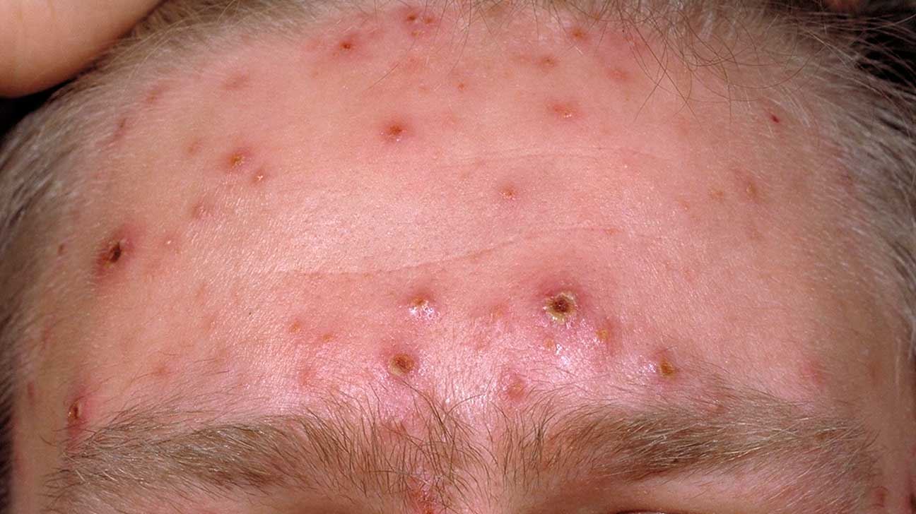 orang dewasa pun boleh terkena chicken pox, semak puncanya disini!