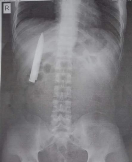 selalu sakit dada, lelaki tak sangka ada pisau 4 inci dalam badan