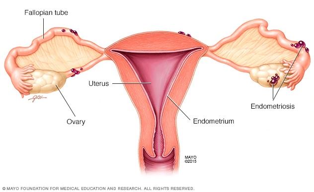 antara penyakit yang sering terjadi pada golongan wanita