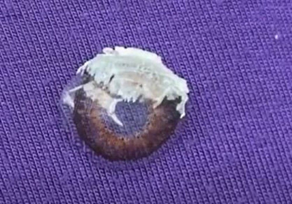 woman almost loses vision after mistaking glue for eye drops