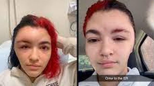 muka gadis remaja bertukar jadi bengkak selepas warnakan rambut sendiri