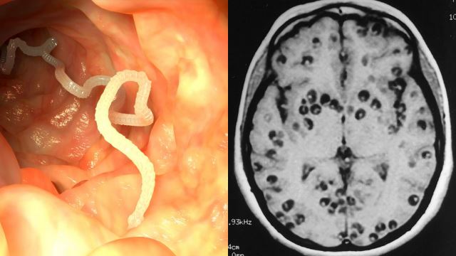 tapeworm-brain-500.png