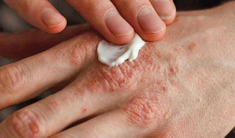 coklat antara makanan perlu elak bagi penghidap ekzema!