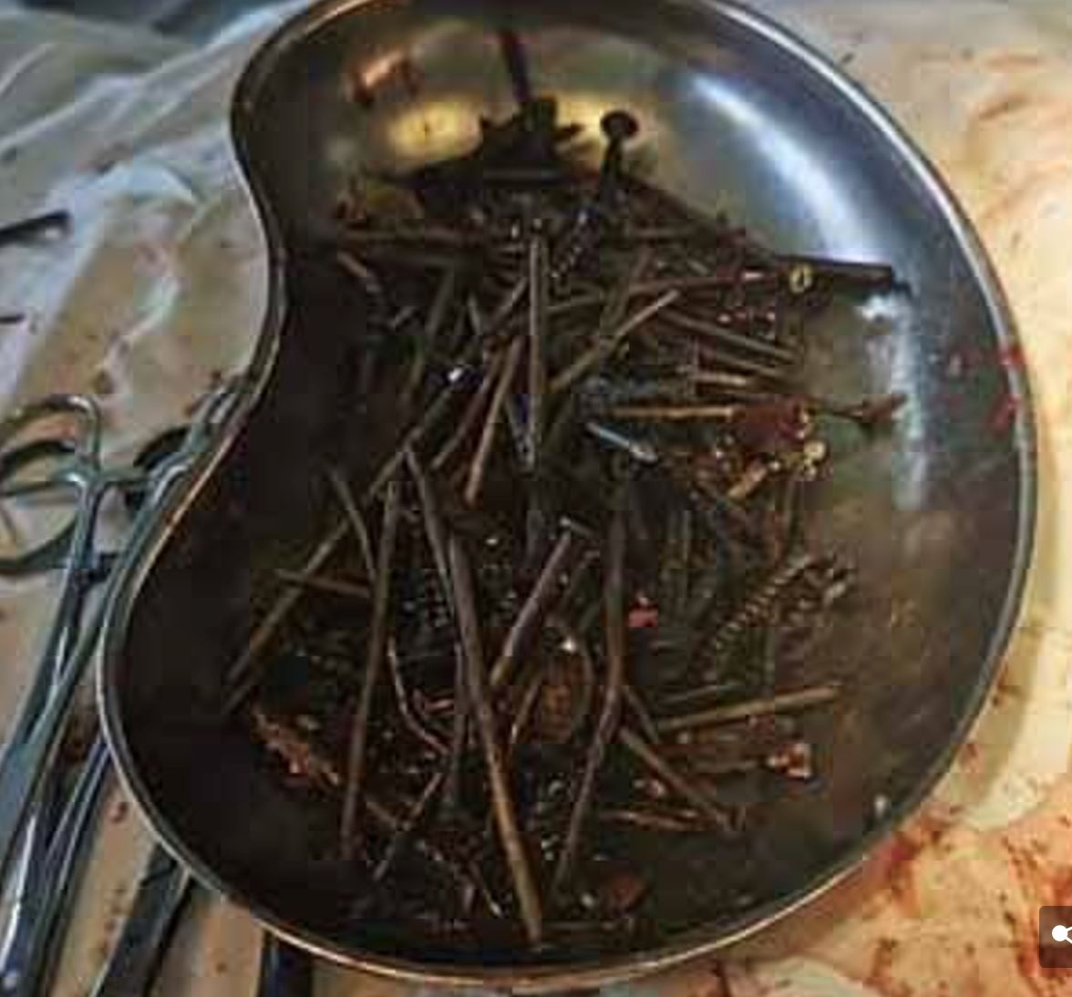 lelaki punyai tabiat makan objek besi mengadu sakit perut, doktor terpaksa lakukan pembedahan kecemasan