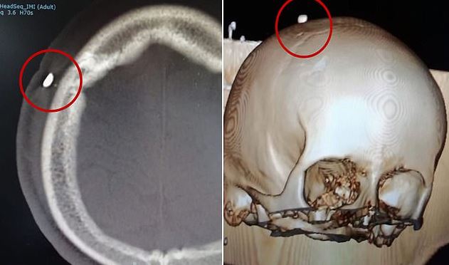 remaja sakit kepala ada gigi terbenam dalam tengkorak lepas digigit rakan