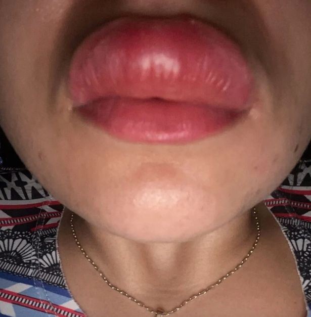 wanita tak sedar bibir disengat lipan sewaktu tidur