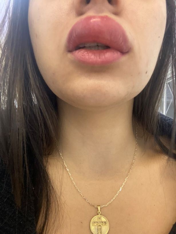 wanita tak sedar bibir disengat lipan sewaktu tidur